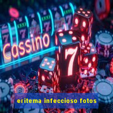 eritema infeccioso fotos